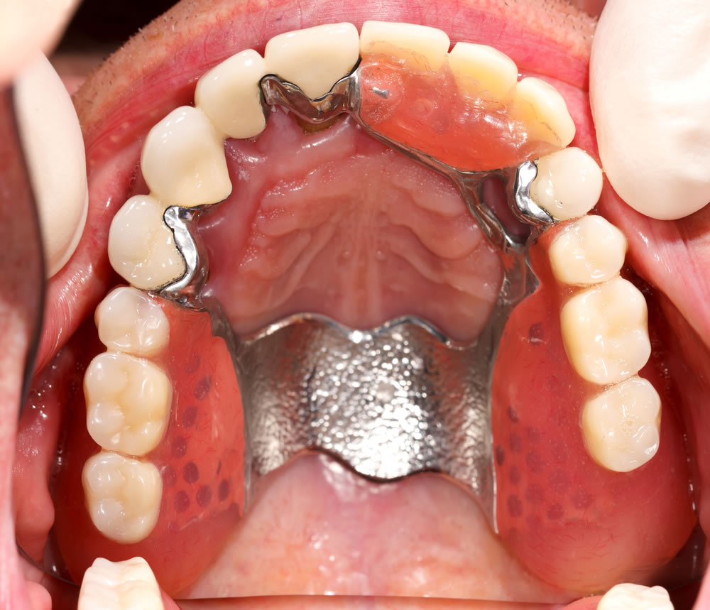 chrome-dentures-mouth