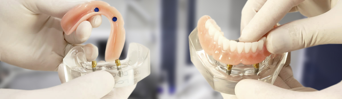 Implant-supported overdentures