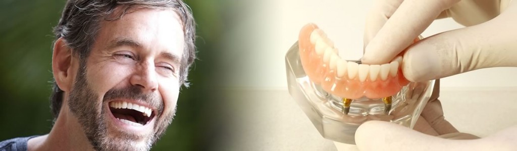 Dental implants in Perth when all teeth are missing