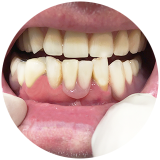 The partial denture is then clipped onto the implant abutment/s – filling the gaps!