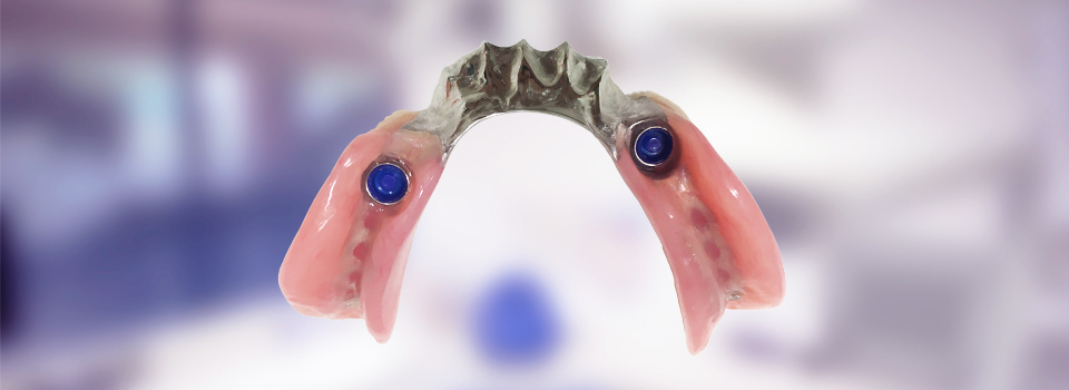 Implant-supported partial denture