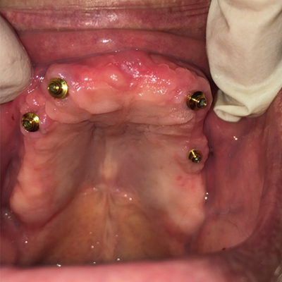 Dental implants in upper jaw