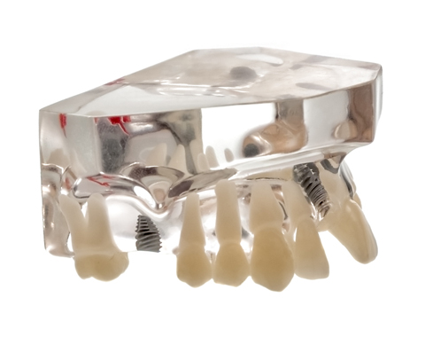 Dental Implants - Implant Dentistry