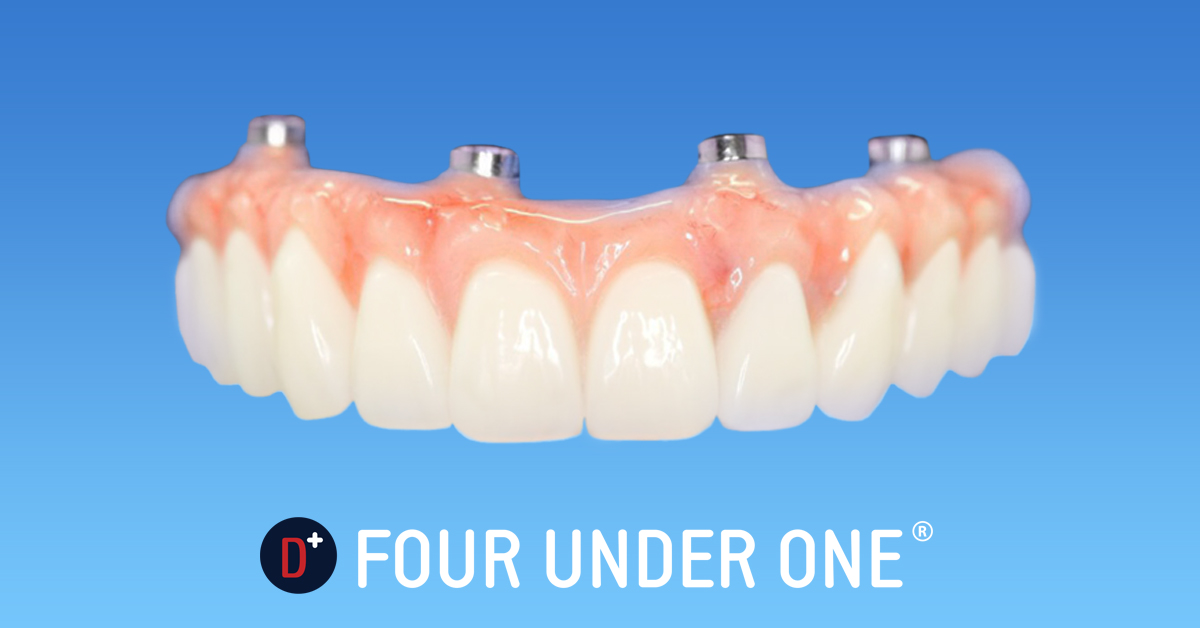 Four Under One (Full Arch Rehabilitation on four dental implants) at Dentures Plus