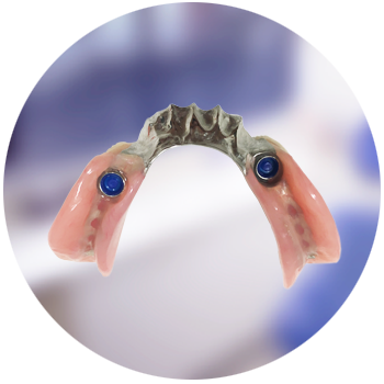 Implant-supported partial dentures