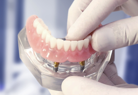 Dental Implant procedures in Leederville (Denture Connect Plus)