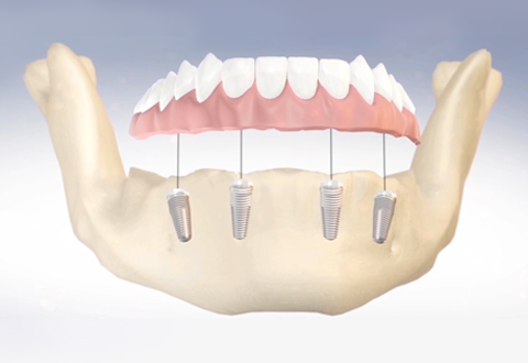 Full Arch Rehab on Four Dental Implants