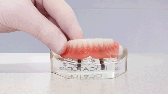 Secure your loose lower denture with the Denture Connect Plus – a permanent but removable solution for convenient cleaning and maintenance